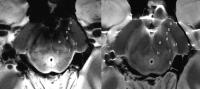 Substantia Nigra Scans (2 of 2)