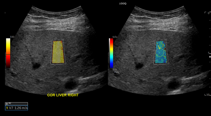 COVID-19 Patients Show Liver Injury Months After Infection