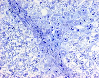Cirrhotic Liver