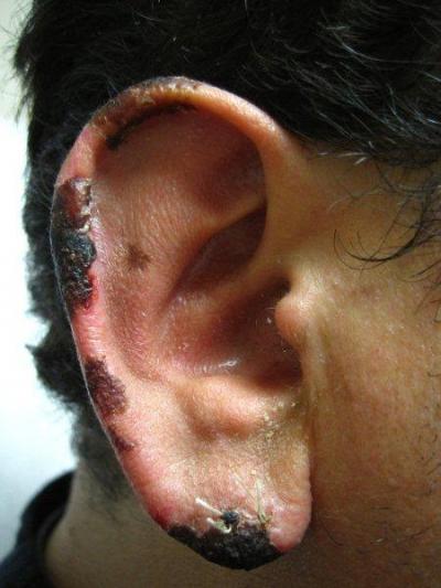 Serious Skin Reaction from Cocaine