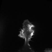 Invasive Tumor Cells (2 of 2)