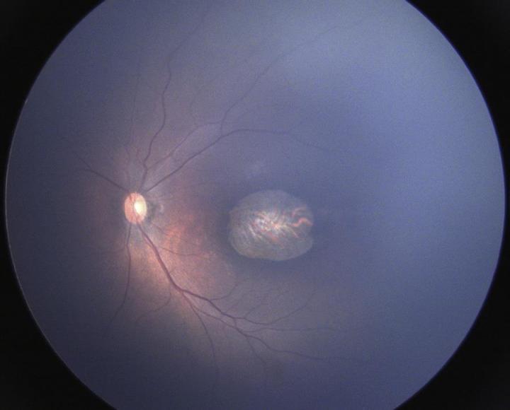 Infants with Congenital Zika Virus Syndrome Suffer Serious Visual Impairment