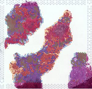 Spatial mapping reveals the complex cellular landscape of prostate tumours.