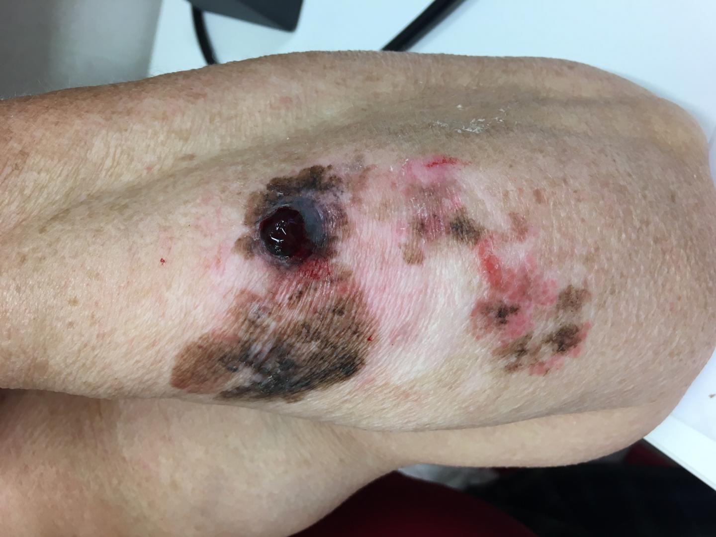 Melanoma on the Limb