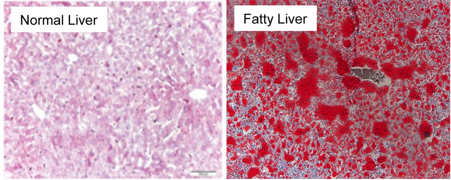 Fatty Liver