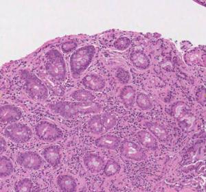Microscopic image showing diseased villi