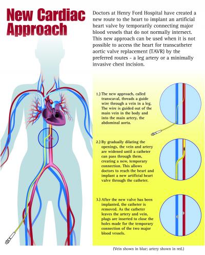 Henry Ford Pioneers New Cardiac Approach