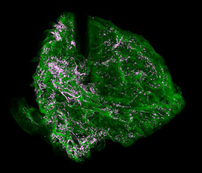 Colorectal cancer cell invasion of liver biomatrices