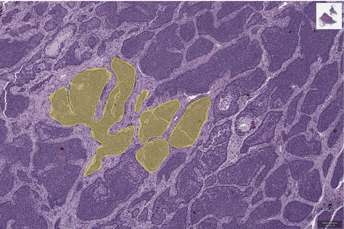 Cancer cell