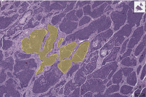 Cancer cell