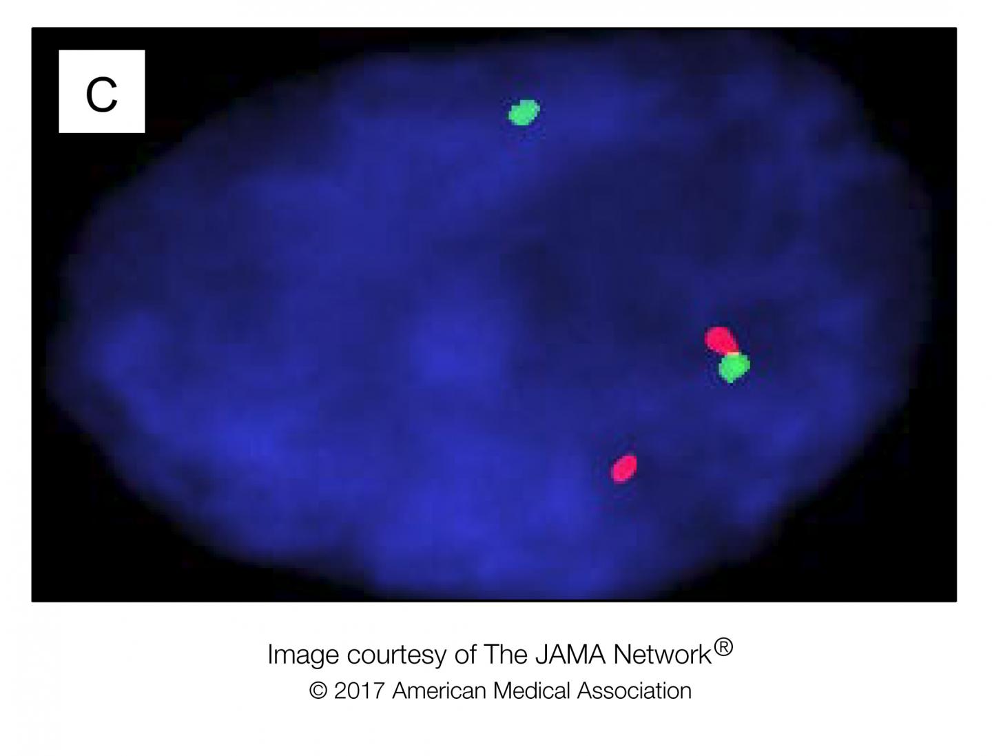 Immunohistochemistry for ALK in Peritoneal Mesothelioma