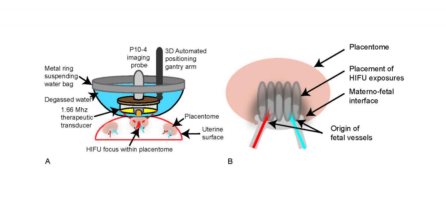 Ultrasound Offers Tool for Blocking Faulty Vessels in Placental Disorder (1 of 2)