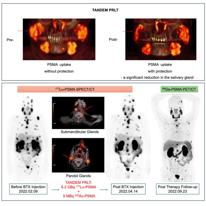 Salivary gland protection with botulinum toxin and scopolamine during tandem PSMA-targeted radioligand therapy.