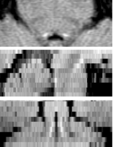 Locus coeruleus in 3T scan