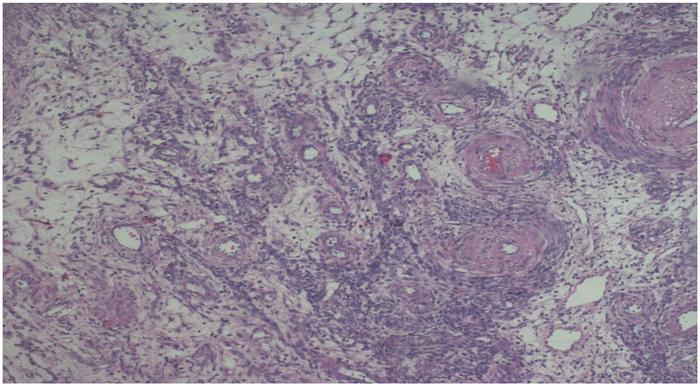 Cervical angioleiomyoma: A rare tumor behind persistent menorrhagia and pelvic pain