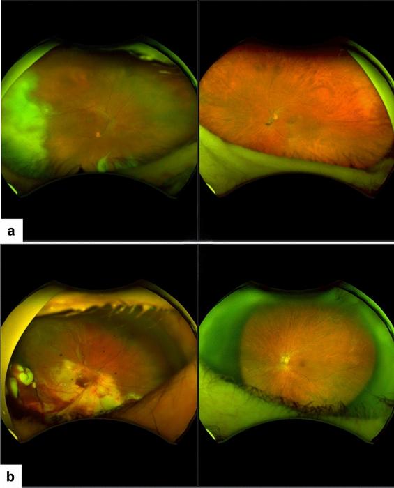 Treatment outcome in endogenous fungal endophthalmitis.