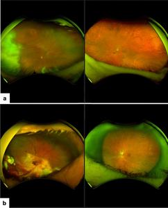 Treatment outcome in endogenous fungal endophthalmitis.