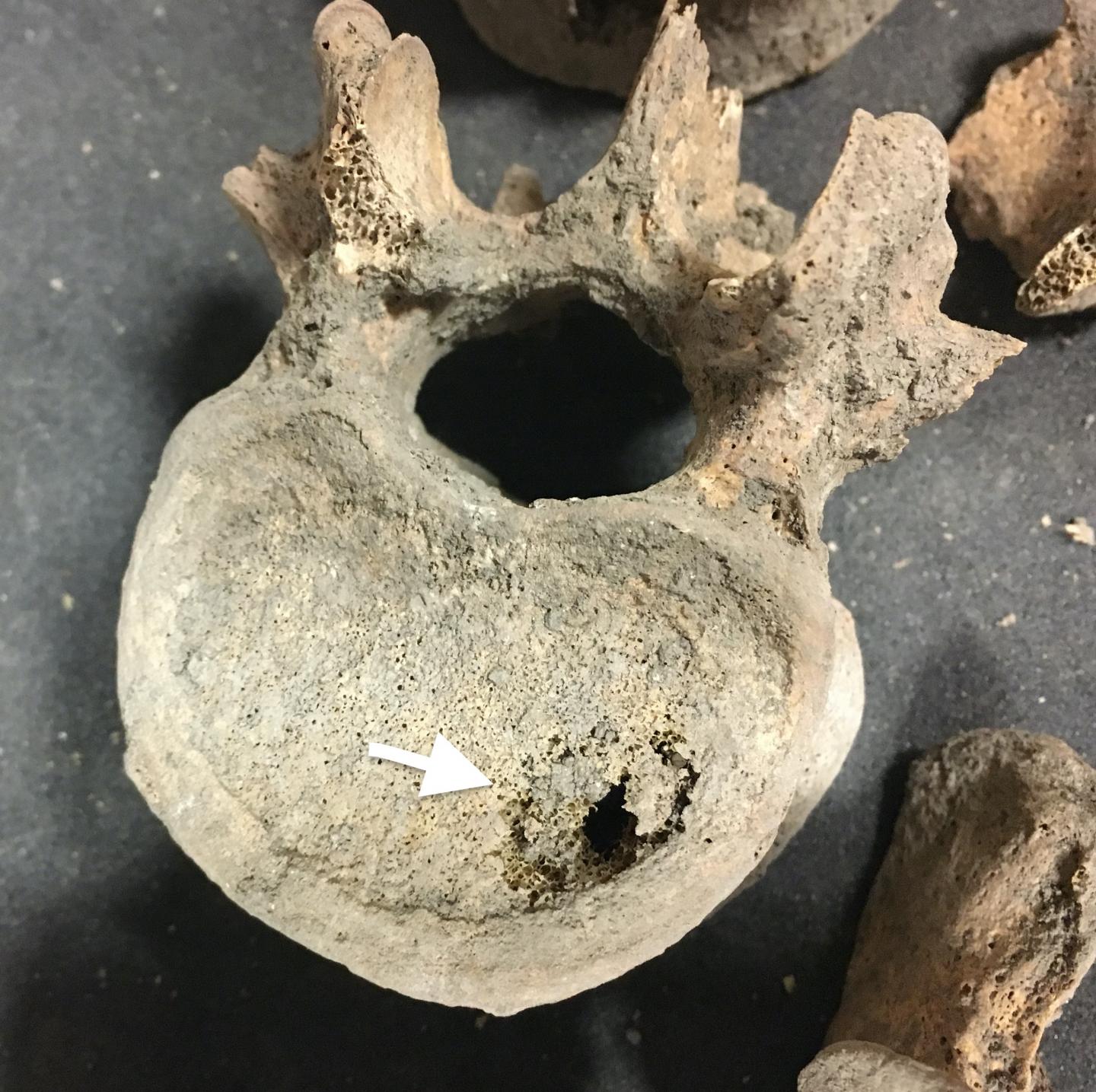 Excavated medieval bone from the spine showing cancer metastases (white arrow)