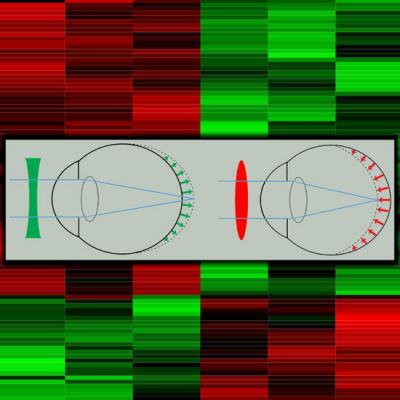 Gene Changes Driving Myopia Reveal New Focus for Drug Development