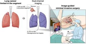 Image of lung cancer surgery
