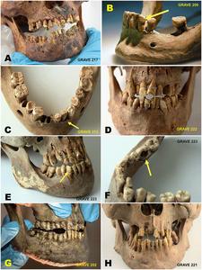 Skeletons in the permafrost: Exploring climate-driven heritage loss and occupational health at the early modern whaling burial site of Likneset, Svalbard