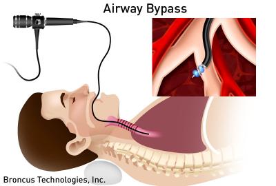 Airway Bypass
