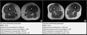 Thigh MRI scans in (A) a 61-year-old female and (B) a 62-year-old female