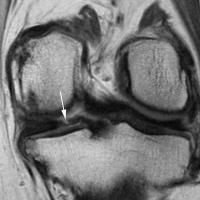 Vertical Tear