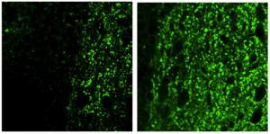 How a chemical reaction triggers brain inflammation in Alzheimer's disease