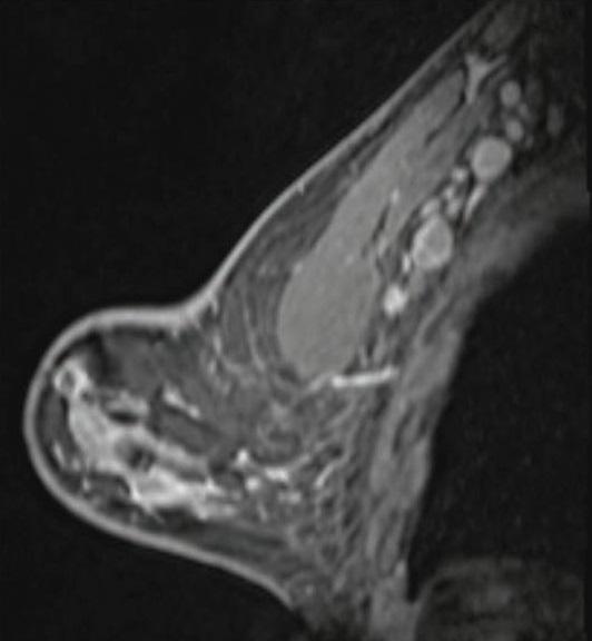 41-year-old woman who underwent high-risk screening breast MRI 15 days after first COVID-19 vaccination dose