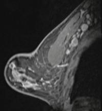 41-year-old woman who underwent high-risk screening breast MRI 15 days after first COVID-19 vaccination dose
