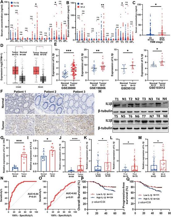 IL-1β is up-regulated in colorectal cancer (CRC) and associated with clinicopathological features.