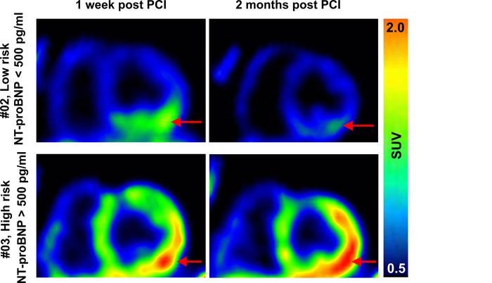 PET imaging after PCI in STEMI patients