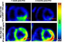 PET imaging after PCI in STEMI patients