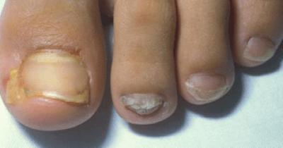 Tinea Unguium