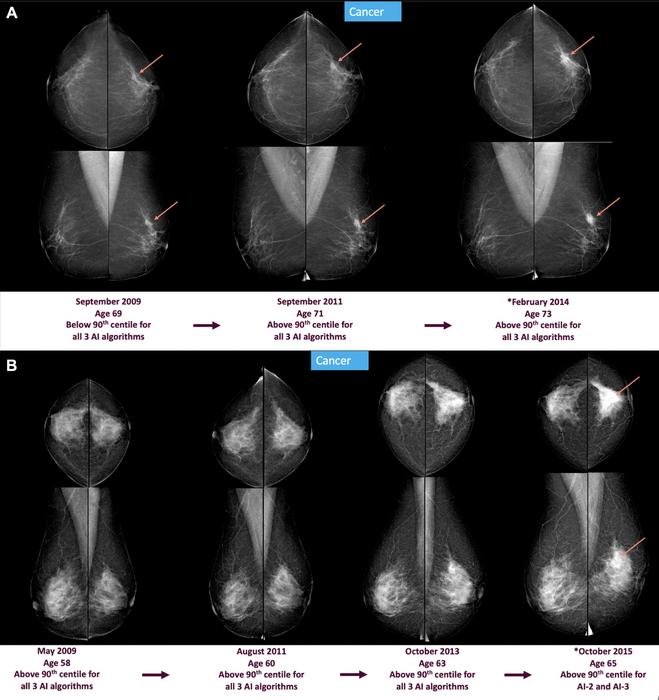 Full-field digital mammograms show craniocaudal (top) and mediolateral (bottom) views of the left and right breast.