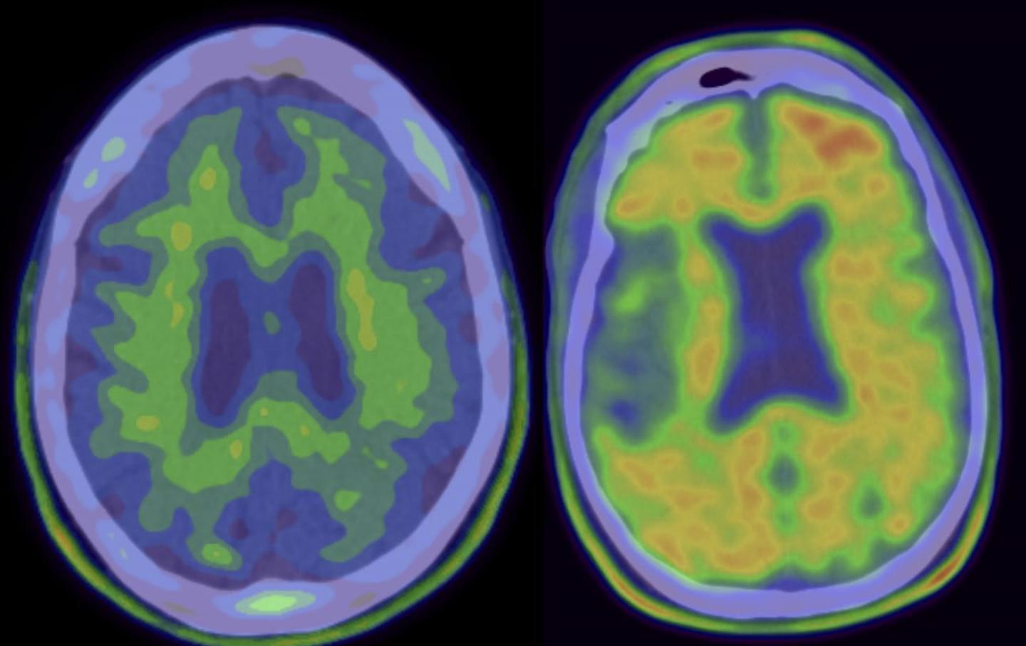 PET Scans