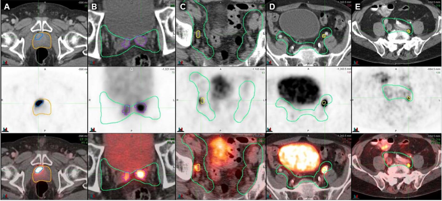 Examples of PSMA-positive Disease Located inside the Radiation Fields