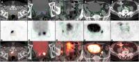 Examples of PSMA-positive Disease Located inside the Radiation Fields
