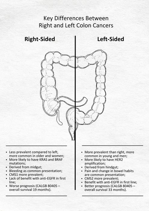 Differential characteristics of colon cancer based on the anatomical location.