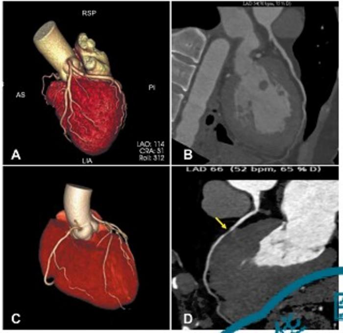 Patients experiencing acute pulmonary embolism without and with pre-existing coronary artery stenosis