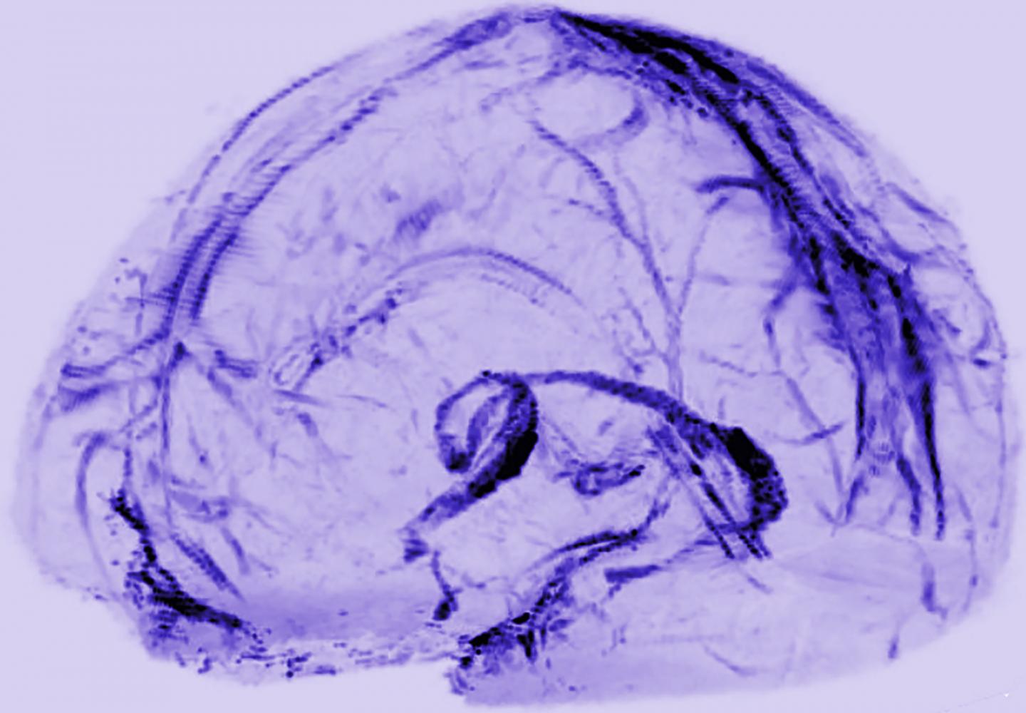 A Brain Drainage System