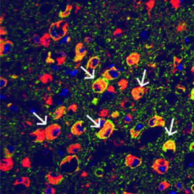 Brain Infections
