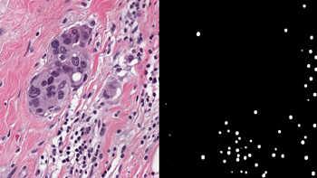 detected-cancer-cells-he-slide