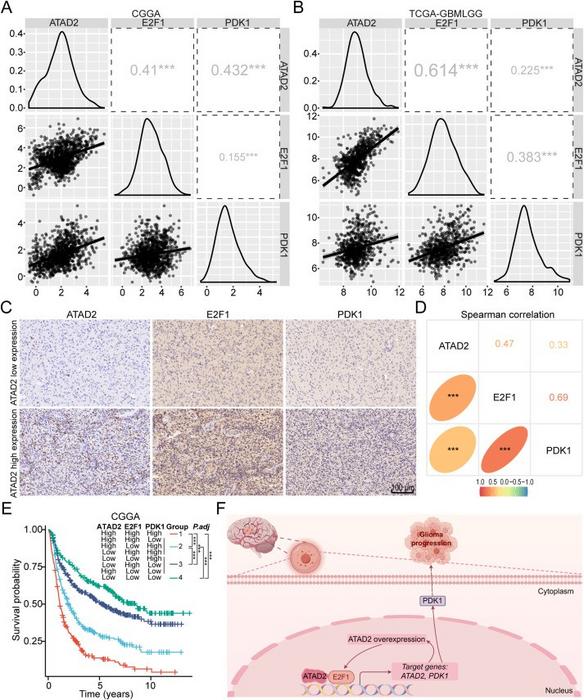 The clinical significance of the ATAD2-E2F1-PDK1 axis in glioma