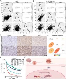 The clinical significance of the ATAD2-E2F1-PDK1 axis in glioma