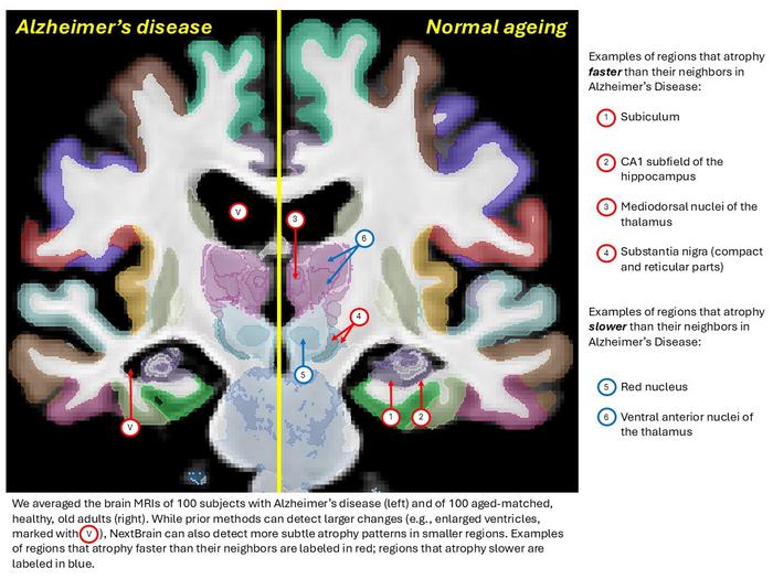 Alzheimer's v normal ageing comparison using NextBrain