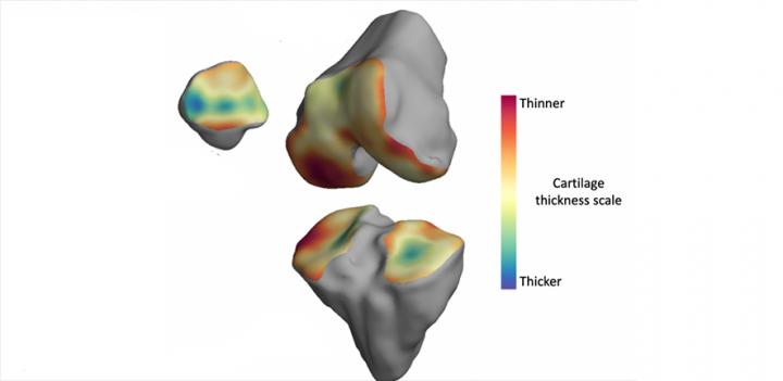 3D Model of Bone Created from MRI Scans