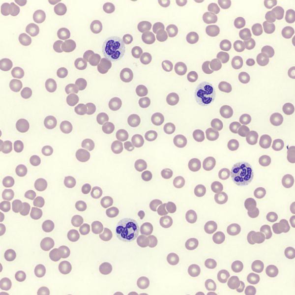 Abnormal Blood