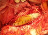 Isolated Prosthesis